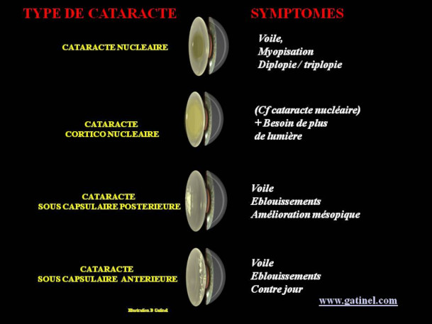 principaux symptômes visuels, et le type anatomique de la ca